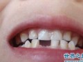 做梦掉牙齿(做梦掉牙齿掉一大把怎么回事)